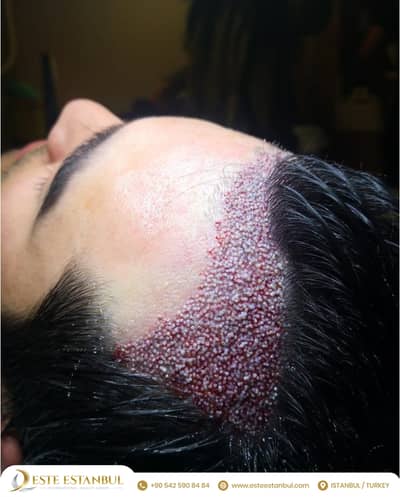 Slider image (1) Este Estanbul - Hair Transplant Clinic Istanbul, Turkey